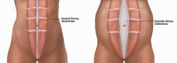 rectus-diastasis